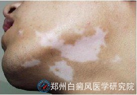 白癜风患者要趁早治疗