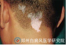 白癜风治疗时需要注意什么